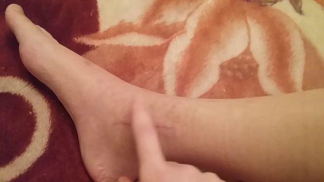 Двухлодыжечный перелом со смещением.
Шрамы после остеосинтеза. смотреть онлайн