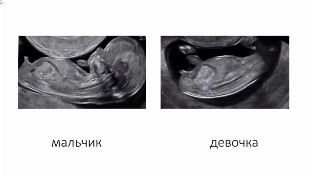 Когда можно определить пол ребенка по узи смотреть онлайн
