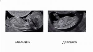 Когда можно определить пол ребенка по узи