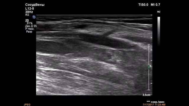 Синдром Педжета Шреттера смотреть онлайн