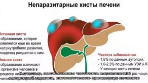 Эффективные способы лечения кисты печени
