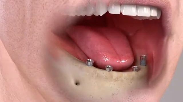 Комбинированный протез на абатментах Locator® смотреть онлайн