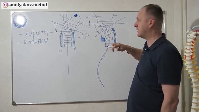 Склолиоз и вытяжка