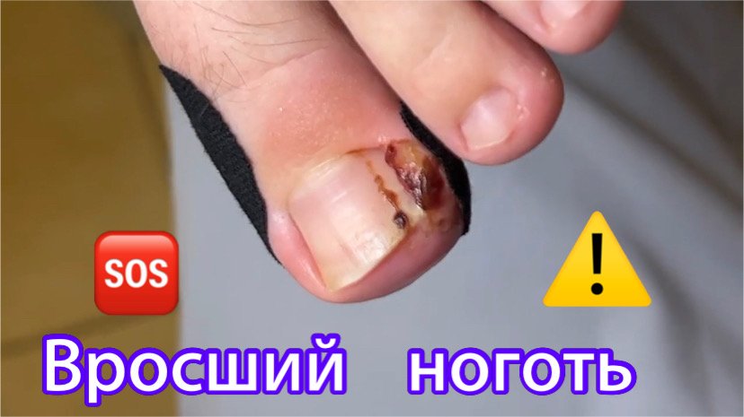 Вросший ноготь?⚠️❗️??