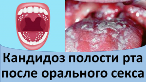 Кандидоз полости рта после орального секса