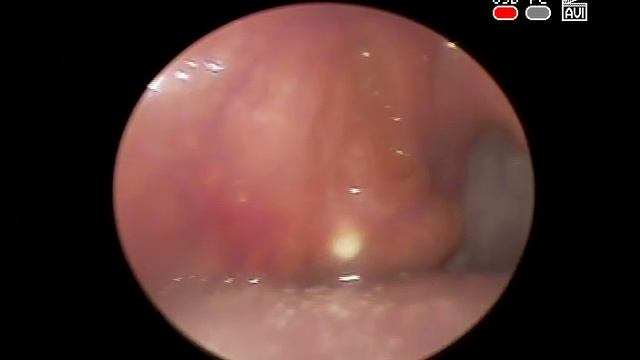 #Tonsil #stone Камень правой небной #миндалины удаление и лечение в КЛИНИКА ОБРАЗЦОВА ЛОР врач смотреть онлайн