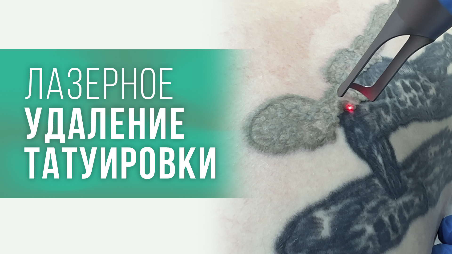 Удаление татуировки в Ready Medical