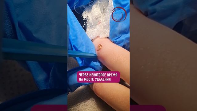 Удаление кератомы лазером смотреть онлайн