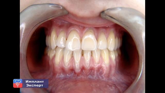 Интересные факты о золотых коронках, которые стоит знать смотреть онлайн