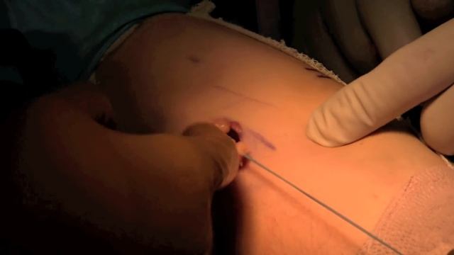Distal Biceps Repair смотреть онлайн
