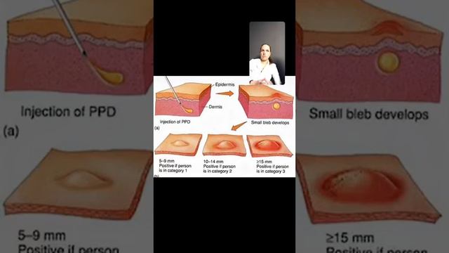 Новости о короновирусе. Туберкулёз смотреть онлайн