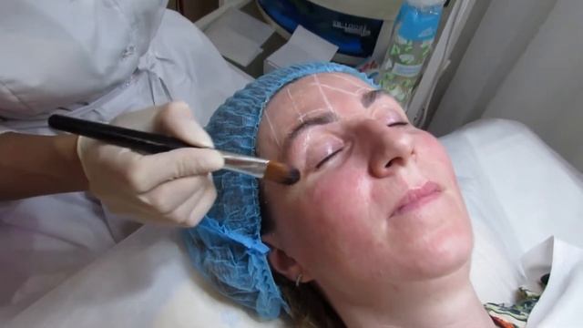 SMAS (СМАС) лифтинг на Оболони в BEAUTY SPA CENTER "IMPULSE" смотреть онлайн