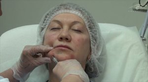 Поднимаем уголки губ Princess. Учеба по контурной пластике PRINCESS