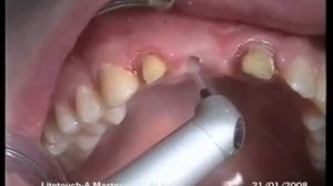 Лазерная имплантация зубов