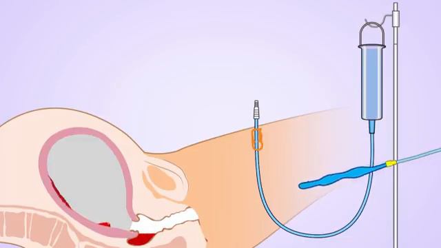 Usage of the Zhukovsky Balloon Tamponade for PPH Free Flow balloon tamponade with logo_36 смотреть онлайн