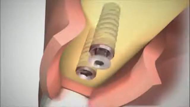Ролик для пациентов . Мостовидный протез . смотреть онлайн