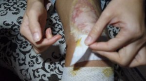 Гидроколлоидная повязка Hydrocoll Thin Hartmann на ожоговой ране