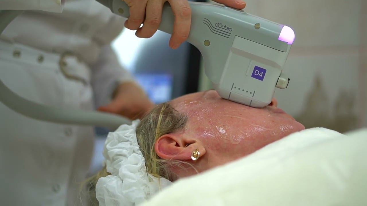 SMAS-лифтинг на передовом аппарате Doublo. смотреть онлайн