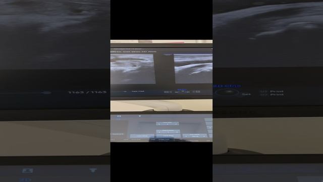 Боли в ногах. Двусторонний гонартроз. Узи сосудов. Сосудистый хирург. Флеболог Москва смотреть онлайн