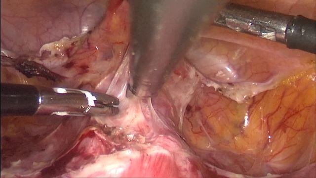 Пектопексия с сохранением матки. Pectopexy with uterus preservation смотреть онлайн