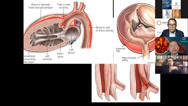 Heartology : "Management of Thoracic Aortic Diseases" смотреть онлайн