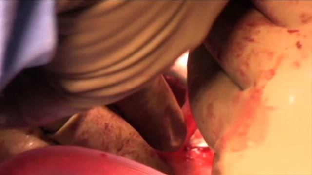 Revision Distal Biceps Repair - Tips Tricks and Pearls for Successful Outcomes смотреть онлайн