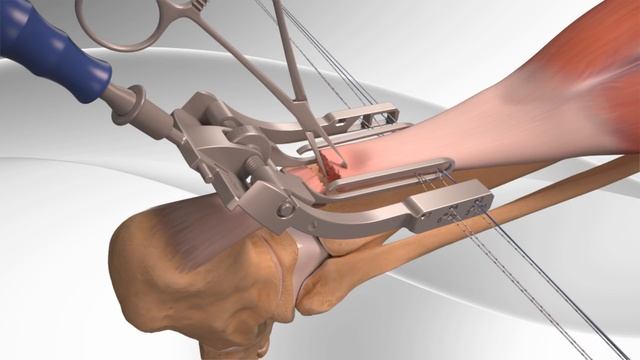 Achilles Tendon Rupture Repair with Arthrex® PARS System смотреть онлайн