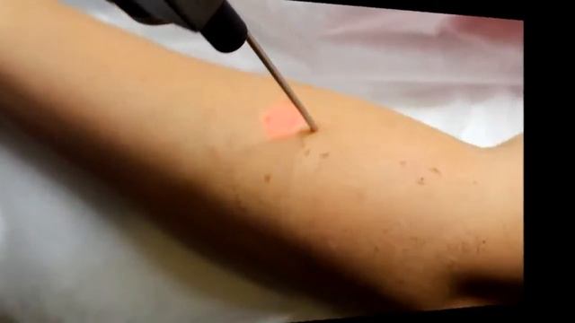 Лазер Эстетик