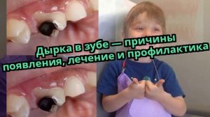 Дырка в зубе — причины появления, лечение и профилактика