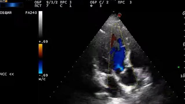 аортальная недостаточность