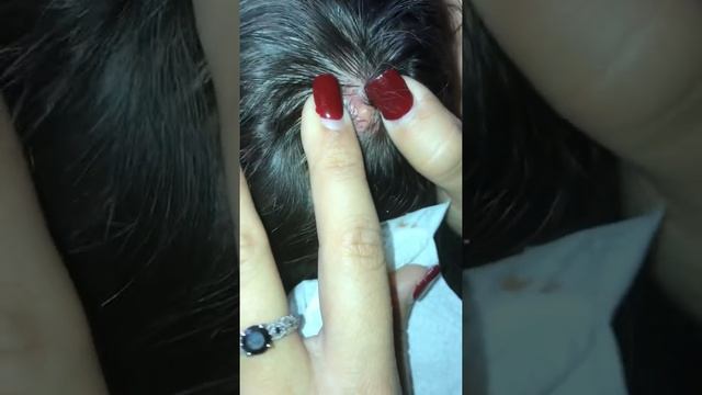 Popping A 3 Year Old Cyst