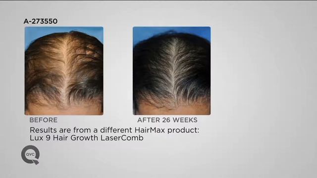 HairMax LaserBand 41 Hair Growth Laser Device on QVC смотреть онлайн