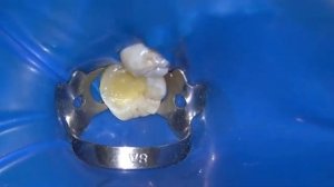 Адгезивная фиксация композитной  вкладки