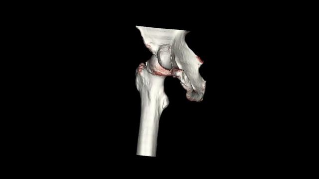 Перелом большого вертела смотреть онлайн