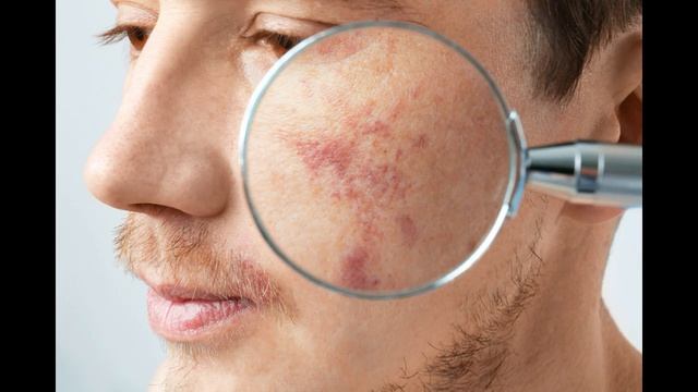 ПЕРВЫЕ СИМПТОМЫ РАКА КОЖИ смотреть онлайн