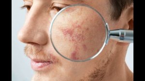 ПЕРВЫЕ СИМПТОМЫ РАКА КОЖИ