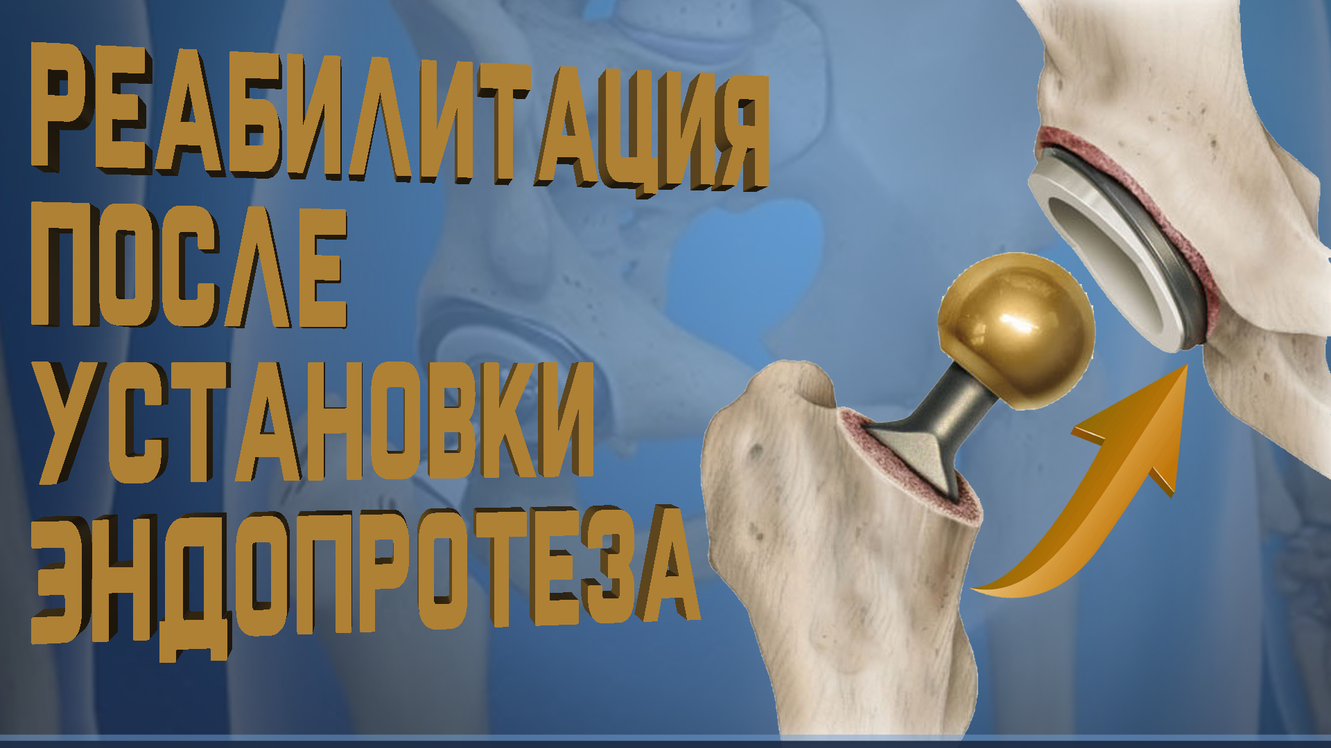 Реабилитация после эндопротезирования. Все что нужно знать! смотреть онлайн