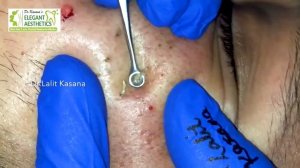 THE BEST BLACKHEADS REMOVAL BY DR. LALIT KASANA PART 2 | BLACKHEADS | DR. LALIT KASANA | PART 2
