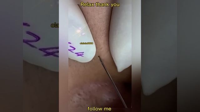 Acne. Blackheads. Ingrown Hairs And Pimple Popping.