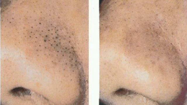 Как избавиться от черных прыщей? смотреть онлайн