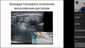 Регионарная анестезия верхней конечности под контролем ультразвука