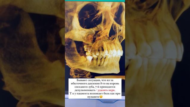 Что могут натворить зубы мудрости😱 смотреть онлайн