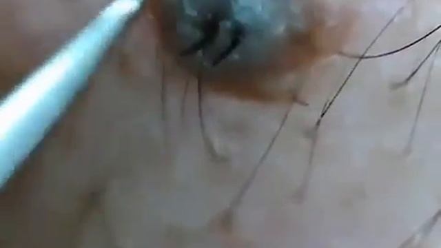 Вросший волос! ГАДОСТЬ смотреть онлайн