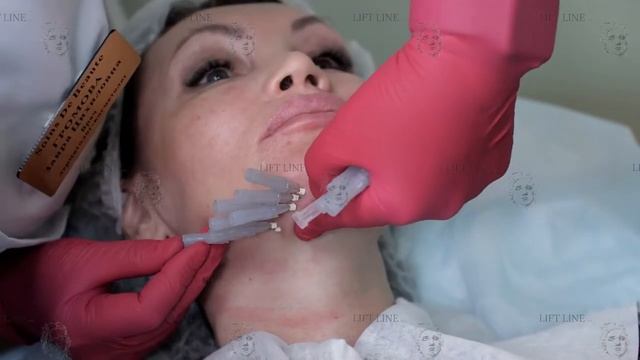 Тредлифтинг подбородка мезонитями Lift Line Nata смотреть онлайн