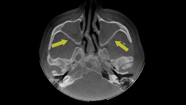 2018 IABDM Phoenix - Dale Miles DDS - Radiographic Signs of Significant Systemic Disease смотреть онлайн