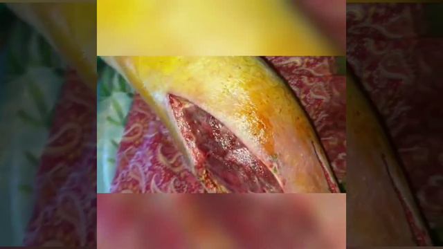 fleqmona qizilyel xesteliyi fesadi agirlasma irinleme emeliyyat mualice fleboloq cerrah roja nekroz смотреть онлайн