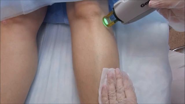 Лазерная эпиляция L-Code Clinic смотреть онлайн