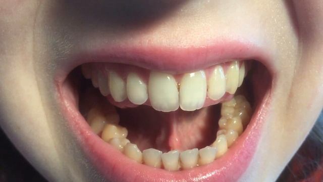 Растягивание подъязычной уздечки: упражнения, лёгкий массаж смотреть онлайн