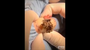 застарелый жировик