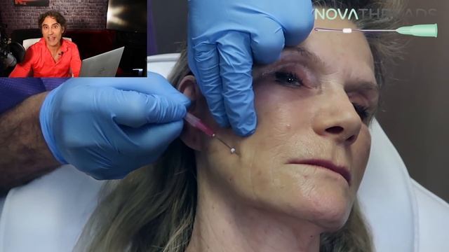 HOW TO GET RID OF SMILE LINES // Smooth LAUGH LINES and MOUTH WRINKLES Before and After смотреть онлайн
